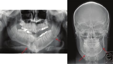 Panoramic Left And Anterior Posterior Right Radiographs