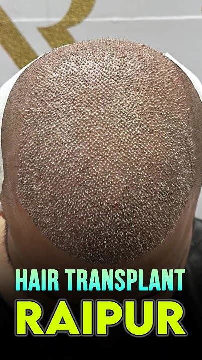 Best Before And After Hair Transplant Results In Raipur Hairtransplantresults Raipur Shorts