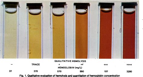 Figure 1 From Effect Of In Vitro Hemolysis On Chemical Values For Serum