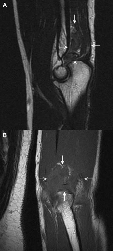 Sagittal MR Images A A Fast Spin Echo T2 Weighted MR Image Showed A