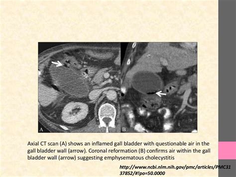 Emphysematous cholecystitis