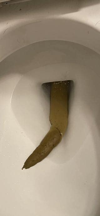 Is this colon cancer pencil thin stool? I have thick stools and then