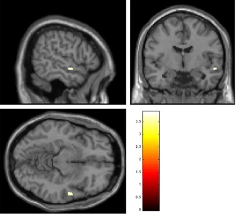 Regions Of Decreased Grey Matter Volume At Baseline In Download