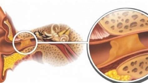 Elimina el Exceso de Cera en los Oídos de Forma Fácil y Natural