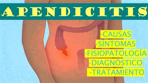 Apendicitis SÍntomas Causas FisiopatologÍa ClasificaciÓn