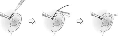 A Simple And Reproducible Surgical Technique For The Management Of