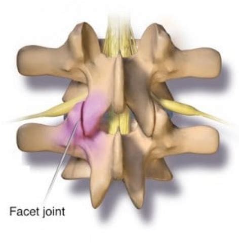 Synovial Cyst Diagnosis And Treatment Nyc Columbia Neurosurgery In New York City