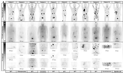 Safety And Efficacy Of 90y Fapi 46 Radioligand Therapy In Patients With