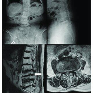 Image of pelvic fracture (Case 1) (a) Pelvic radiograph taken 1 week ...