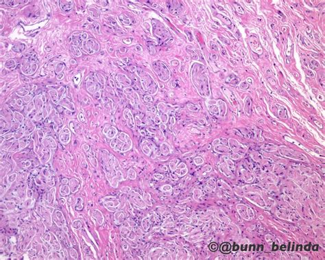 Traumatic Neuroma Pathology Outlines