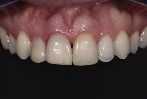 Right Central Incisor Lost Due To External Resorption White Implants