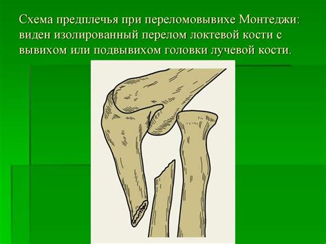 Повреждения предплечья и кисти - презентация онлайн