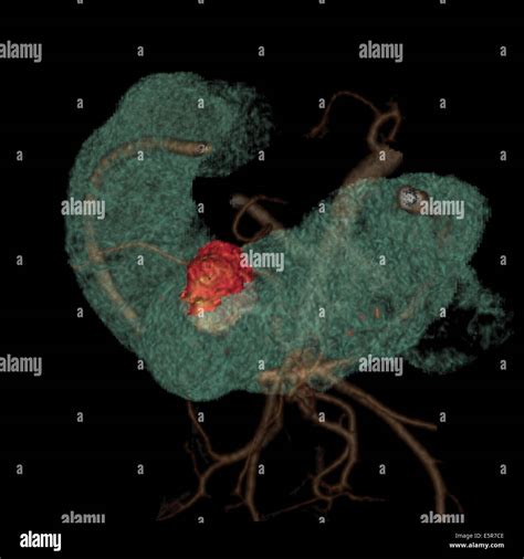 Three Dimensional Computed Tomographic Reconstruction Scan Of The Small