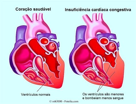 Insufici Ncia Card Aca Congestiva Aguda Ou Cr Nica Sintomas Tratamento