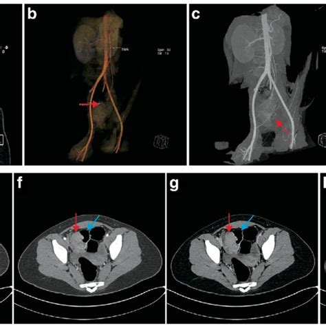 Abdominal And Pelvic CT Scan 3D Reconstruction And ECT Demonstrating