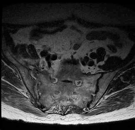 Sacroiliac Joint Dysfunction Mri