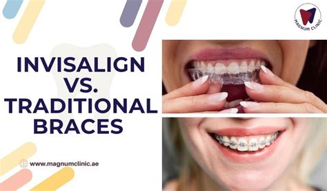 Invisalign Vs Traditional Braces Which Option Is Right For You