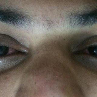 Moderate lid edema, conjunctival congestion with mild chemosis and ...