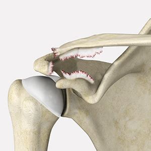 AC Joint Separation Treatment Durham NC | Morrisville Shoulder Injuries