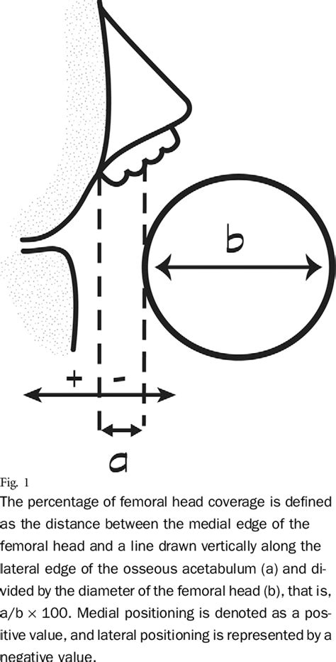 Ultrasonographic findings in hips with a positive Ortolani sign and their relationship to Pavlik ...