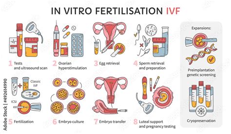 In Vitro Fertilization Ivf Vector Infographic And Infertility Treatment