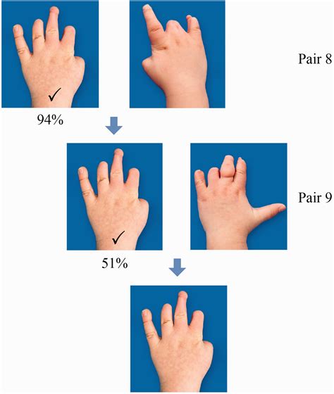 Amniotic Band Syndrome Hand