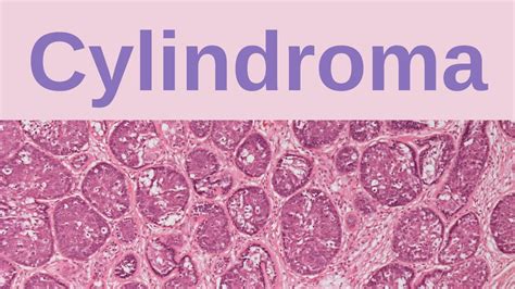 Cylindroma Pathology Mini Tutorials YouTube