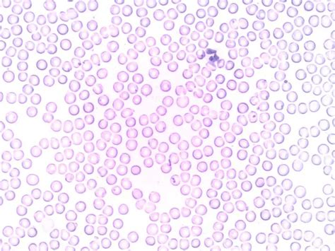 White Blood Cells - Types, Observations, Counts and Urine Analysis