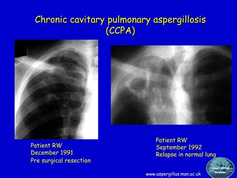 Ppt The Extraordinary Spectrum Of Diseases Caused By Aspergillus Powerpoint Presentation Id