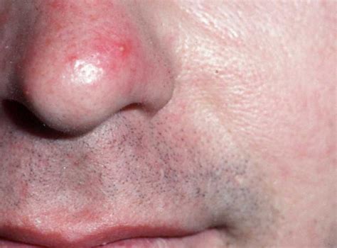 Types Of Rosacea Bumps And Pimples Rosacea Can Often Be C Flickr