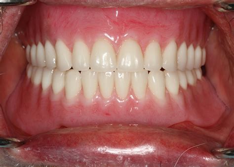 Case Implant Retained Complete Upper And Lower Dentures