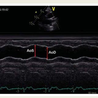 Measurements Of Systolic Aos And Diastolic Aod Diameters Of The