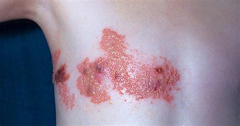 Shingles Scars