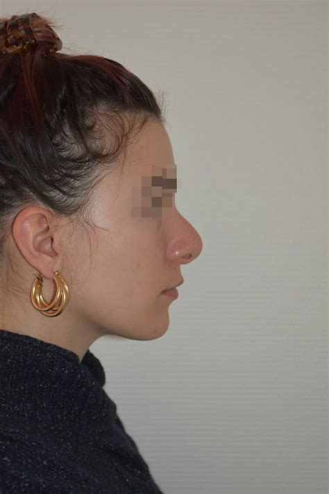 Rhinoplastie Secondaire avant après dr martin rhinoplastie