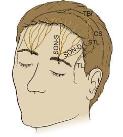 Supraorbital Nerve Block for Supraorbital Neuralgia | Clinical Gate