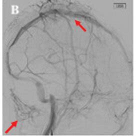 Preoperative Digital Subtraction Cerebral Angiography Coronal View