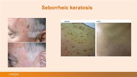 Seborrheic Keratosis Treatment | Seborrheic Keratosis Removal