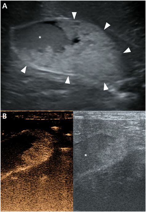 Frontiers Case Report Imaging Features Of Gallbladder Sessile Polyp