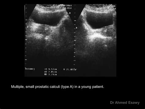 Imaging Prostatitis Urethritis Dr Ahmed Esawy Ppt