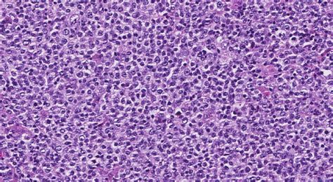 Diffuse large B cell lymphoma | Ottawa Atlas of Pathology