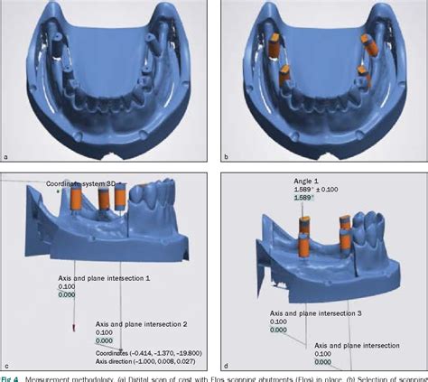 Figure 3 From Accuracy Of Digital Vs Conventional Implant Impression