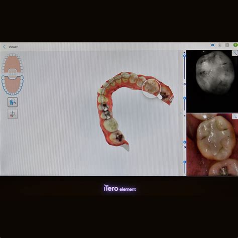 Digital Cavity Detection Dentist Chandler AZ 85224 Delta Dentist