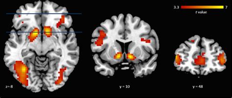 Main Effect Of Model Free RPEs With Significant Activations Seen In