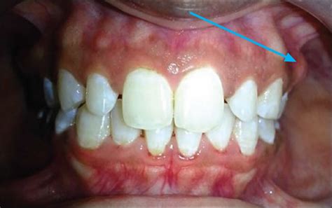 Exostosis causes, symptoms and exostosis treatment