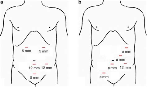 Intracorporeal Stapled Ileocolic Anastomosis With Mechanical Closure Of