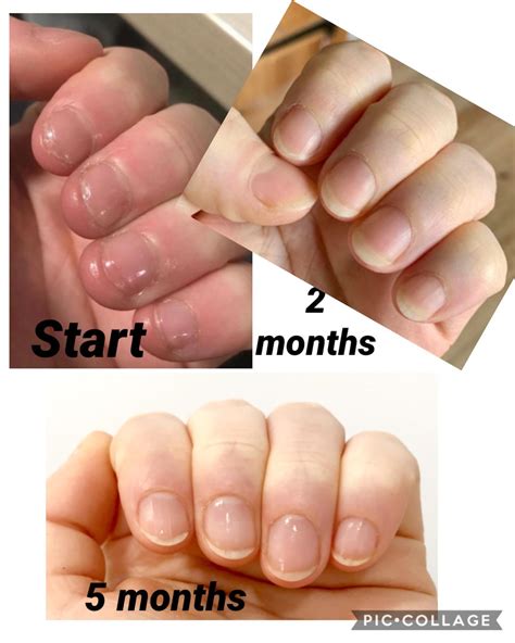 You Just Need To Remember The Process Is Very Slow But Nail Beds WILL