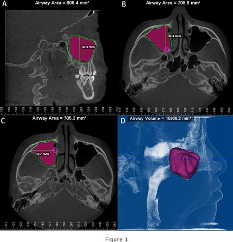 Figure 1 From Correlation Between The Size Of The Maxillary Sinus And