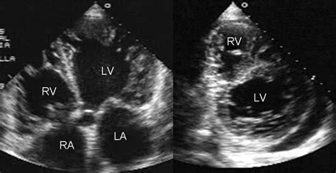 Normal Echocardiogram