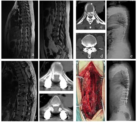 Ossification Of Posterior Ligament