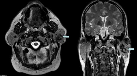 Axial And Coronal T1 Weighted A And T2 B Respectively Mri